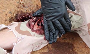 INTERNAL HEMORRHAGE COMPRESSION