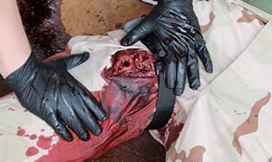 LOWER EXTREMITY LIFE