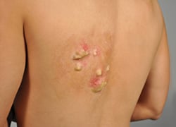 2ND DEGREE PARTIAL THICKNESS BURN