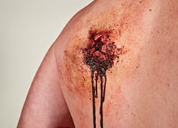 GUNSHOT EXIT WOUND