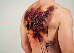 PENETRATING SHRAPNEL WOUNDS