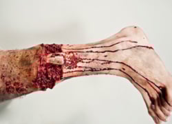 COMPOUND FIBULA FRACTURE