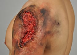 UPPER EXTREMITY 3RD DEGREE BURN