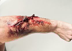 FOREARM LACERATION WITH SHRAPNEL