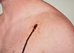 GUNSHOT ENTRANCE WOUND