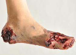 PARTIAL FOOT AMPUTATION