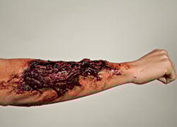 FOREARM LACERATION