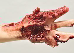 PARTIAL HAND AMPUTAION