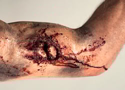 COMPOUND HUMEROUS FRACTURE