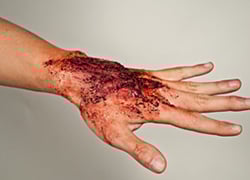 DORSAL HAND 1ST & 2ND DEGREE BURNS
