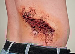 SUPERFICIAL LARGE LACERATION