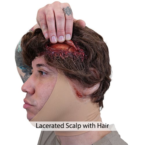 TAMK-Lacerated-Scalp